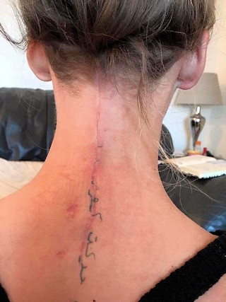 Samantha's scar following surgery