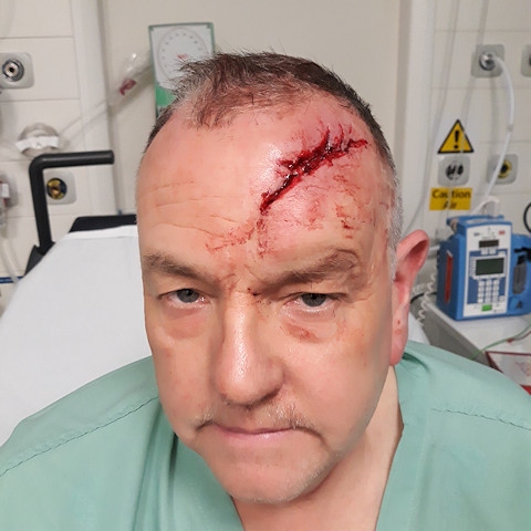 Paul Schofield was hit over the head with a baseball bat