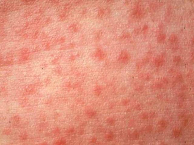 301 new measles infections were also confirmed in the period between April and June 2019 