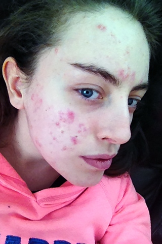 Giorgia Frost has suffered from acne since eight years of age
