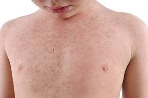 Check your family's MMR vaccinations are up-to-date. Pictured: a child with measles