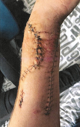 The injury to the victim's arm