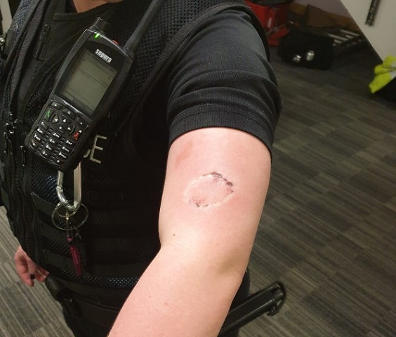 The bite injury suffered by the police officer