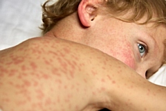 Child with measles
